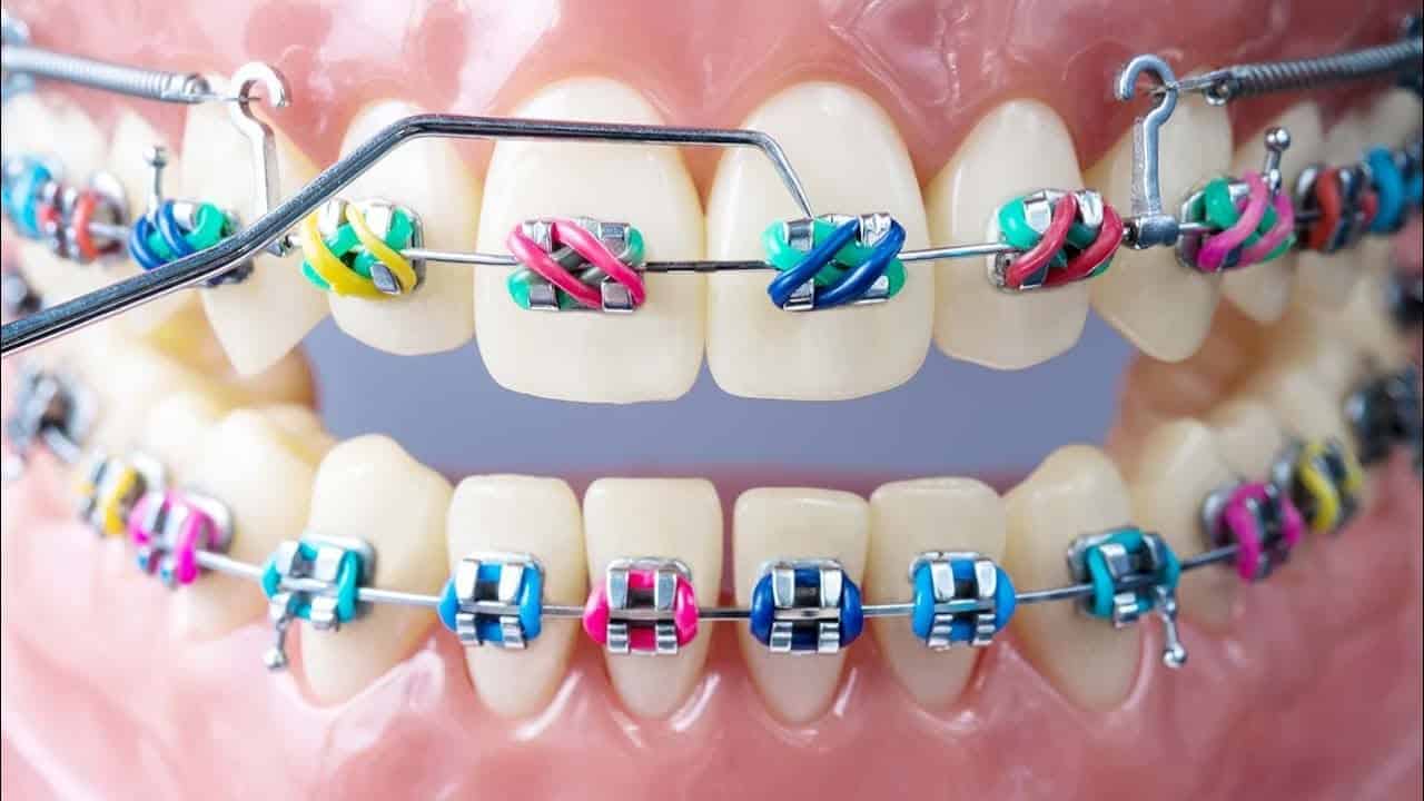 اورینگ ارتودنسی در رنگ بندی متنوع با کیفیت عالی